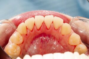 Teeth-and-irritated-gums-close-up-gum-disease