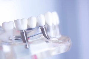 Dental Bridge