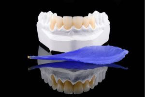 Dental Veneers