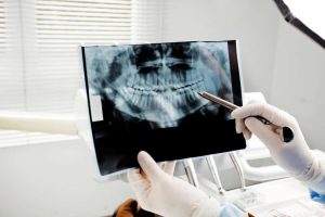 Dental X-Ray
