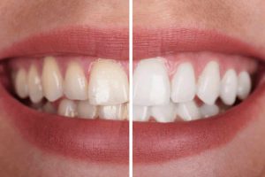 Teeth Whitening (2)