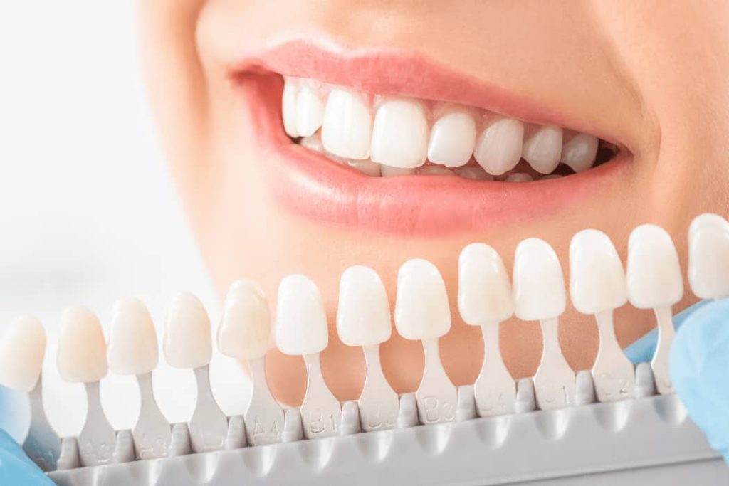 Teeth Whitening (3)