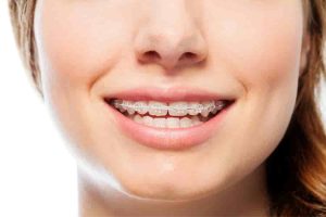 Orthodontic Treatment (1)
