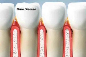 Gum Disease (3)