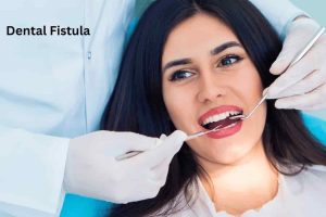 Dental Fistula (1)