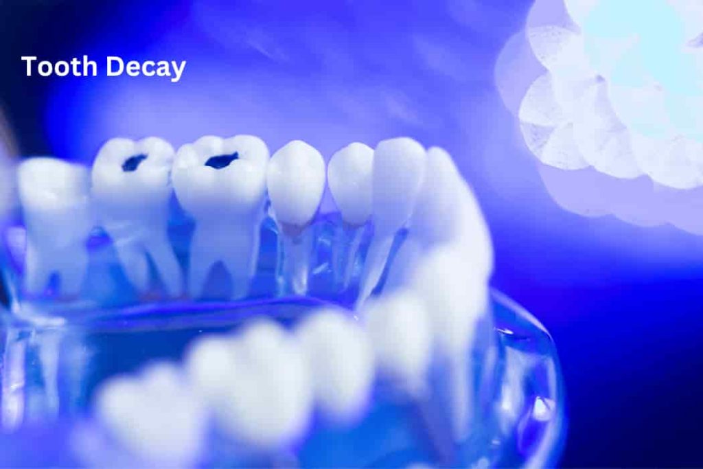 Tooth Decay (2)