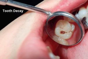 Tooth Decay (3)