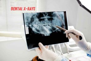 Dental X-rays (1)