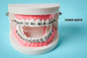 Trench Mouth (1)