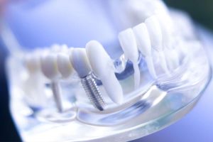 Dental Abscess