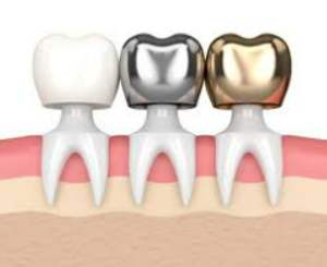 A tooth with gold, silver, and white crowns, highlighting diverse cosmetic dentistry options.