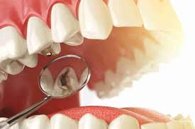 A tooth model with a dental tool, highlighting a cavity for reference.