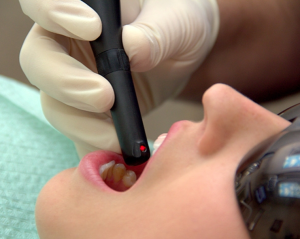 A patient receives a toothbrush cleaning with laser cavity detection for better care.