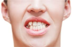 A man displaying a smile with a missing tooth, illustrating the effects of teeth misalignment.