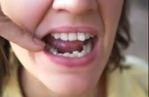A woman smiling, showcasing her teeth, highlighting issues of teeth misalignment.