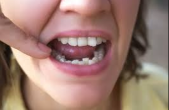 A woman smiling, showcasing her teeth, highlighting issues of teeth misalignment.