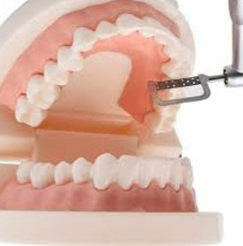 A dental implant model and toothbrush illustrating interproximal reduction techniques.