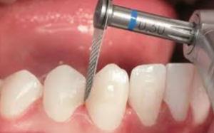 A dental professional uses a drill for interproximal reduction to clean teeth effectively.