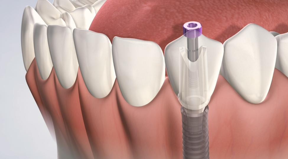 Image of a tooth with a dental implant, showcasing dental implants and pain management.
