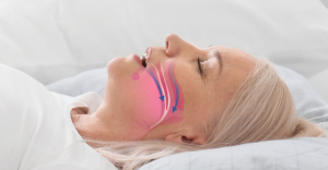 A woman in bed, head on a pillow, reflecting on sleep apnea symptoms.