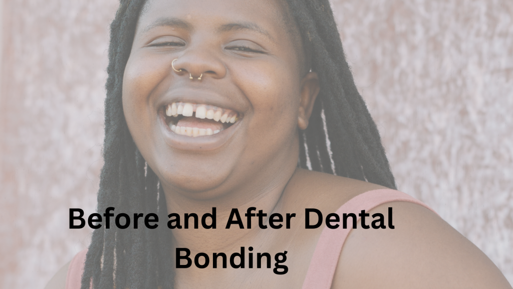 Before and after images of dental bonding, showing improved tooth appearance and alignment.