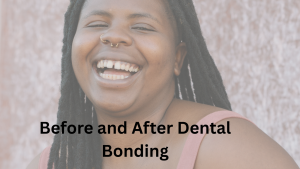Before and after images of dental bonding, showing improved tooth appearance and alignment.
