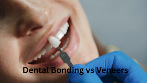 Comparison image of dental bonding and veneers, highlighting their appearance and application differences.