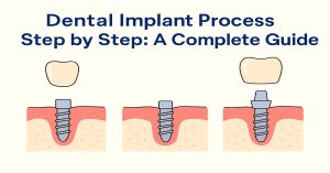 Dental Implant Process Step by Step A Complete Guide
