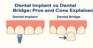 Dental Implant vs Dental Bridge Pros and Cons Explained