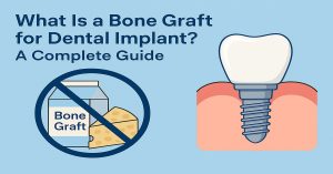 What Is a Bone Graft for Dental Implant A Complete Guide