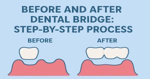 Before and After Dental Bridge Step-by-Step Process