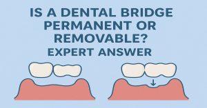 Is a Dental Bridge Permanent or Removable Expert Answer