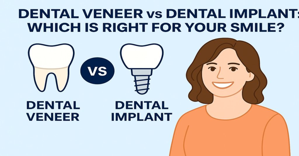 Dental Veneer vs Dental Implant Which Is Right for Your Smile