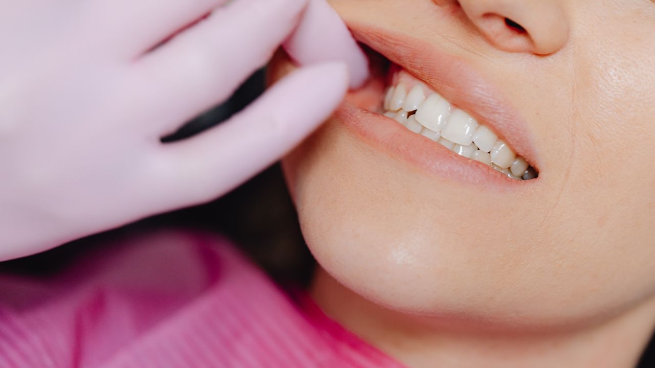 dental bonding for gaps before and after