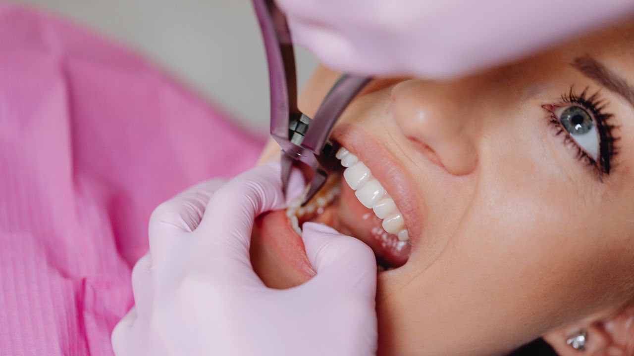 is dental composite bonding permanent